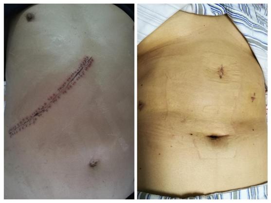 肝膽血管外科獨立開展腹腔鏡下肝血管瘤切除術