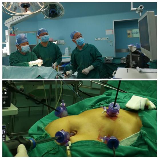 肝膽血管外科獨立開展腹腔鏡下肝血管瘤切除術