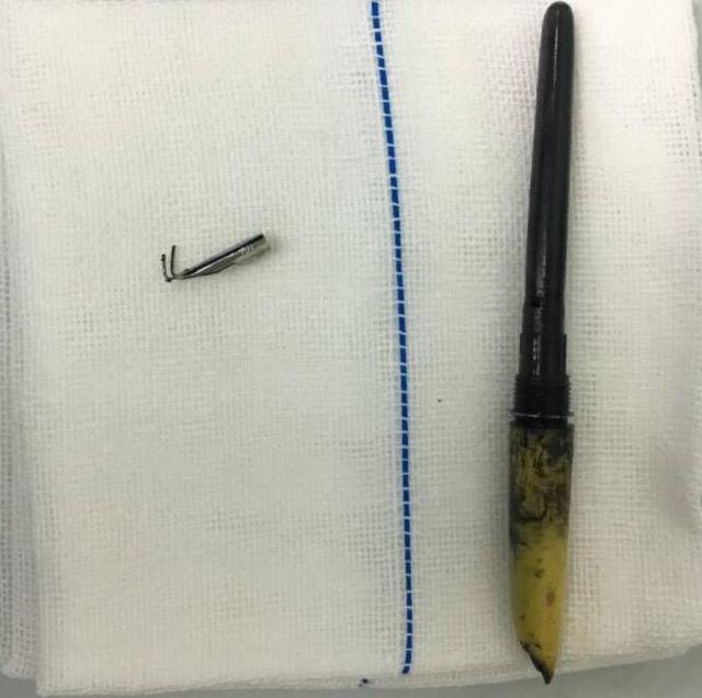 眼二科：鋼筆戳入眼瞼，手術6小時順利取出，患者眼球保住